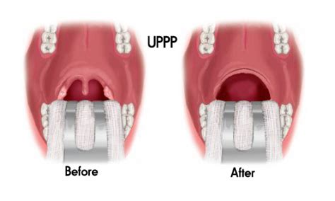 Uppp Uvulopalatopharyngoplasty About