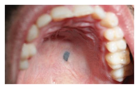 Palatal Lesion During Oral Examination Download Scientific Diagram