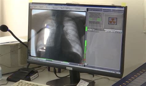 Улан удэнцы могут сдать новый анализ на туберкулез