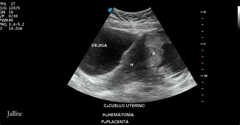 Placenta Previa And Hematoma Retroplacentario