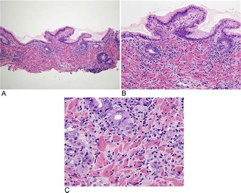 Hematoxylin And Eosin Stain Of Gastric Mucosal Biopsy A B Gastric