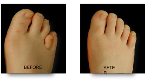 Brachymetatarsia Brachymet Short Toe — Foot Ankle Surgery