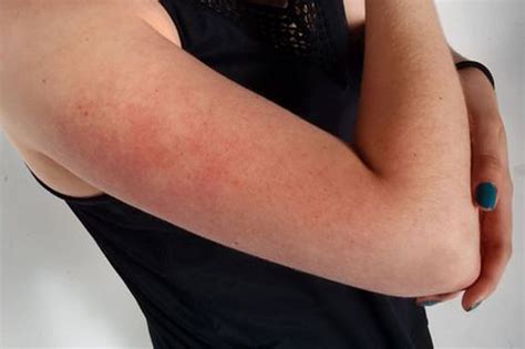 Why You Get Those Red Bumps On Your Arms And How To Get Rid Of Them