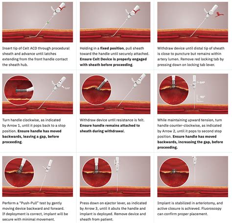 Safety And Efficacy Of The Celt Acd Femoral Arteriotomy Closure Device