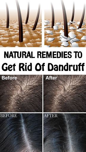 Remedies For Getting Rid Of Dandruff