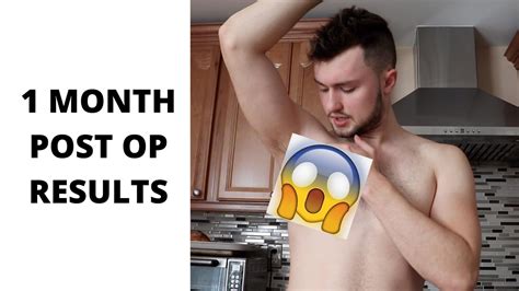 Month Post Op Gyno Surgery Results Youtube