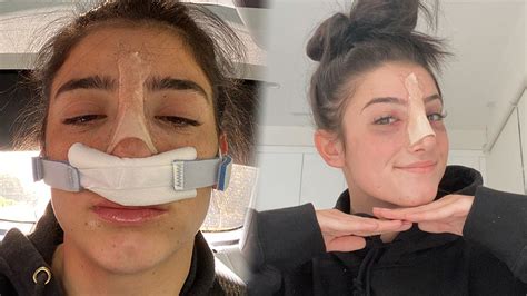 Dixie Damelio Mocks Trolls Who Say She “copied” Charlis Nose Surgery