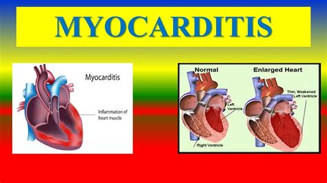 Myocarditis Definition Types Pathophysiology Complications