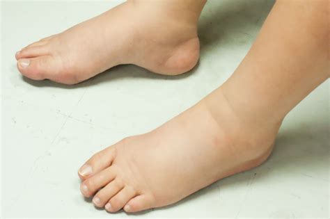 Causes Of Swollen Ankles In Diabetics Diabeteswalls