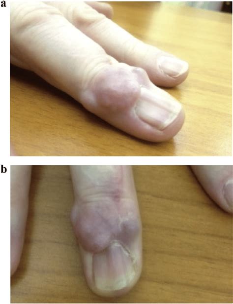 A Swelling Over Dip Joint Masquerading As Digital Ganglion Cyst With
