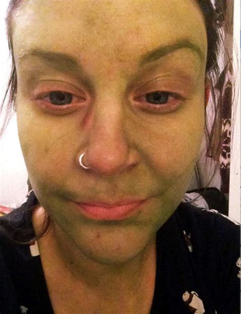 Woman S Skin Stained Bright Green Like Incredible Hulk After Using St Tropez Self Tan Daily Star