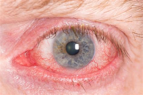 Scleritis Inflammation Of The White Of The Eye Causes Symptoms And