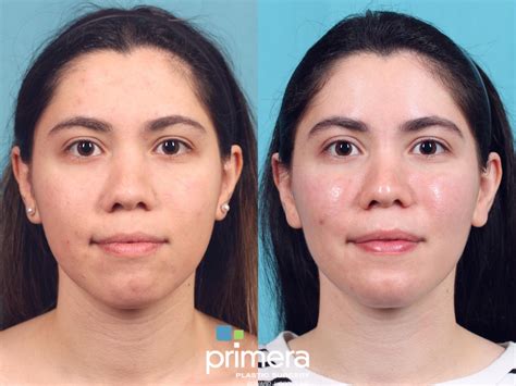 Buccal Fat Removal For Orlando And Winter Park Fl Primera Plastic Surgery