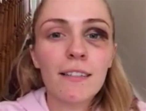 Video The Young Woman With A Black Eye Everyones Watching