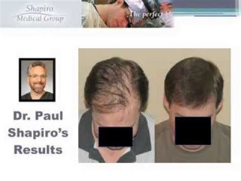 Hair Transplant Result with Shapiro Medical Group ...