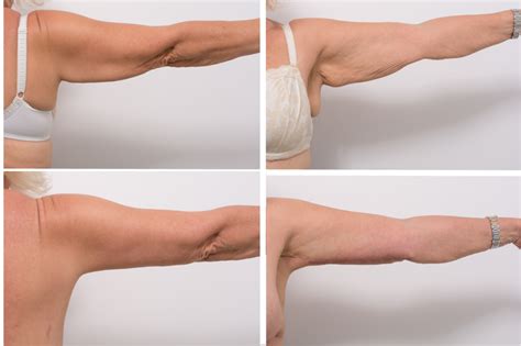 How to get rid of arm flab in 2 weeks. Brachioplasty, or Arm Lift with Dr Eddie Cheng