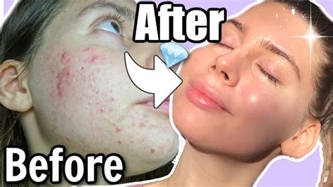 How I Got Rid Of Textured Skin And What You Should Know Youtube