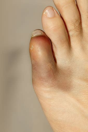 Little Toe With Severe Inflammation And Bruising Stock Photo Download