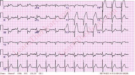 Anterior Wall ST Segment Elevation Myocardial Infarction MI ECG