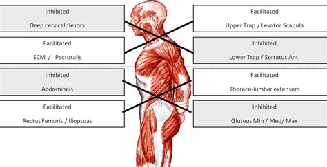 Upper Crossed Syndrome