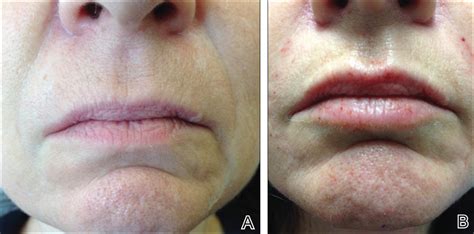 Current Concepts In Lip Augmentation Mdedge Dermatology