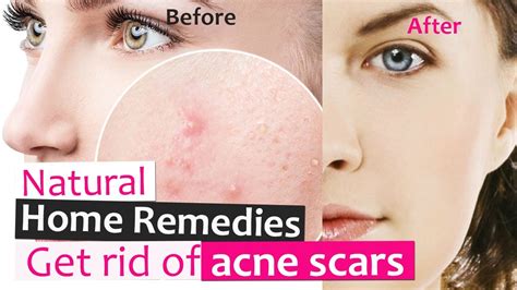 How To Get Rid Of Acne And Scars Overnight Natural Home Remedies That
