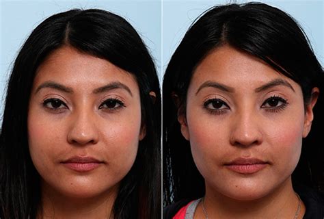 Buccal Fat Pad Removal Photos Houston Tx Patient 27817