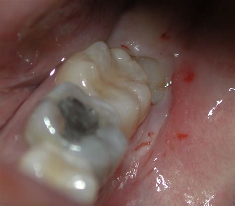 Wisdom Tooth Extraction U Dental Clinic