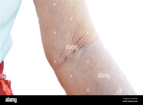 Aging Skin Folds Or Skin Creases Or Wrinkles At Arm And Forearm Of