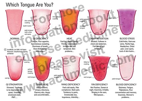 Tonguechartcamdenacumedictcmlondon Acumedic Clinic