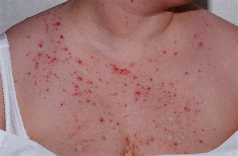 Back Acne Causes And Best Treatment To Get Rid Of Back Acne And Scars