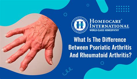 Psoriatic Arthritis In Homeopathy ‣ Arthritis Homeocare International