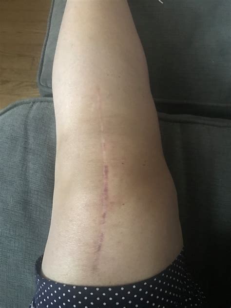 It is most commonly performed for osteoarthritis, and also for other knee diseases such as rheumatoid arthritis and psoriatic arthritis. Knee Replacement Scar Recovery Timeline: A Photo Gallery
