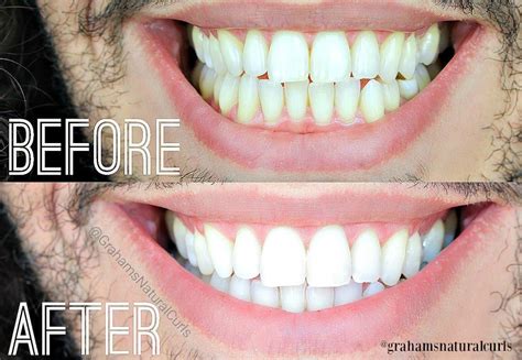 Pin On Teeth Whitening Before And After Results