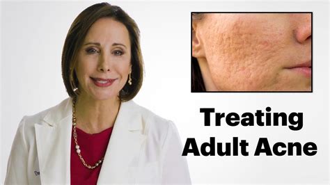 How To Treat Acne In Adults Allure Youtube