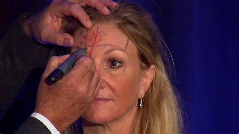 Injectors Anatomy Of The Forehead Youtube