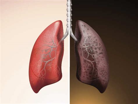 lung cancer mild cough non smokers lung cancer lungs smoker vs reasons around thinkstock