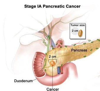 Pancreatic cancer often goes undetected until it's advanced and difficult to treat. Pancreatic cancer Symptoms, Signs and Treatment | Science ...