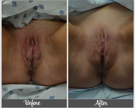 Before And After Labiaplasty Pictures Tampa Florida