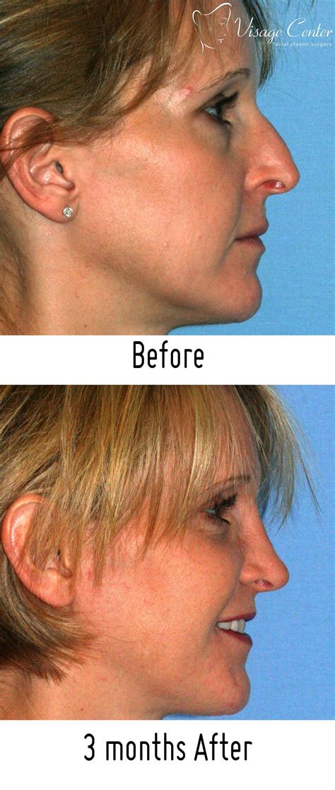 Rhinoplasty Nose Surgery Is One Of The Most Popular Procedures In