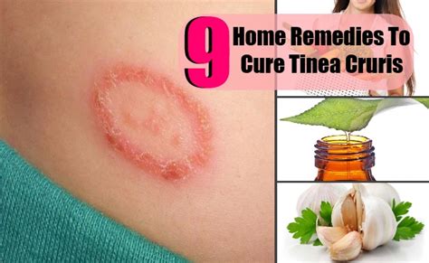 9 Top Home Remedies To Cure Tinea Cruris Lady Care Health