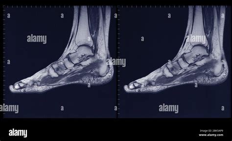 Foot And Ankle Mri Stock Photo Alamy