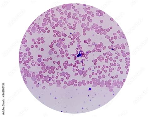 Microscopic View Of Hematological Slide Showing Pancytopenia A