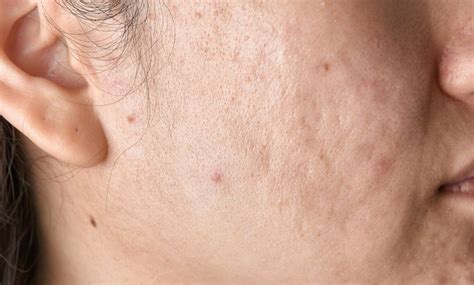 Acne Scars Treatment And Removal In Las Vegas