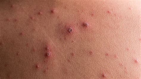 10 Symptoms Of Chicken Pox Facty Health