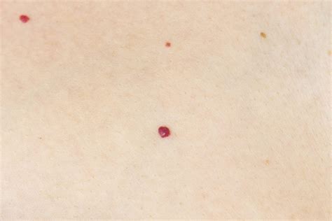 Cherry Angioma Cherry Angiomas Pictures Symptoms Causes