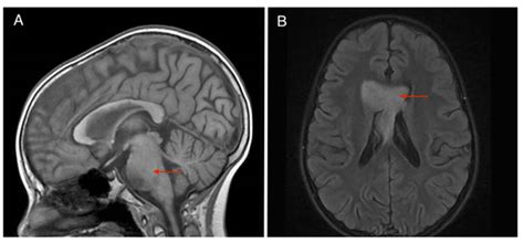 Dipg brain tumour is an aggressive form of childhood brain cancer. Analysis of a progressive diffuse intrinsic pontine glioma ...