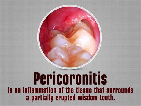 Pericoronitis Is An Inflammation Of The Tissue That Surrounds A