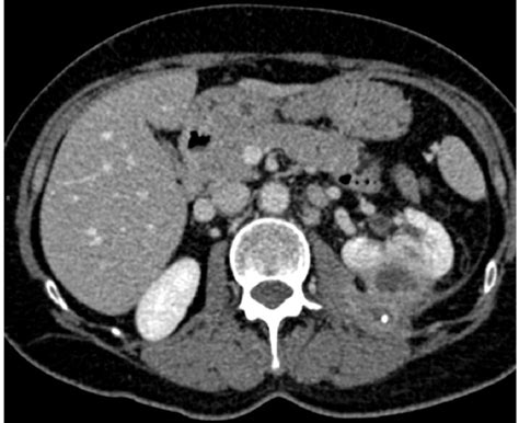 Figure 4 From The Perinephric Space And Associated Extra Renal