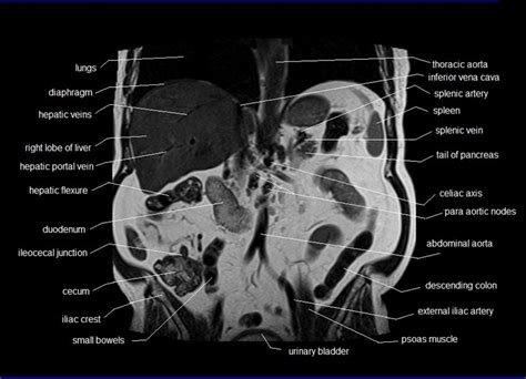 General anatomy and the musculoskeletal system: anatomy human abdomen | MRI abdomen coronal anatomy | free ...